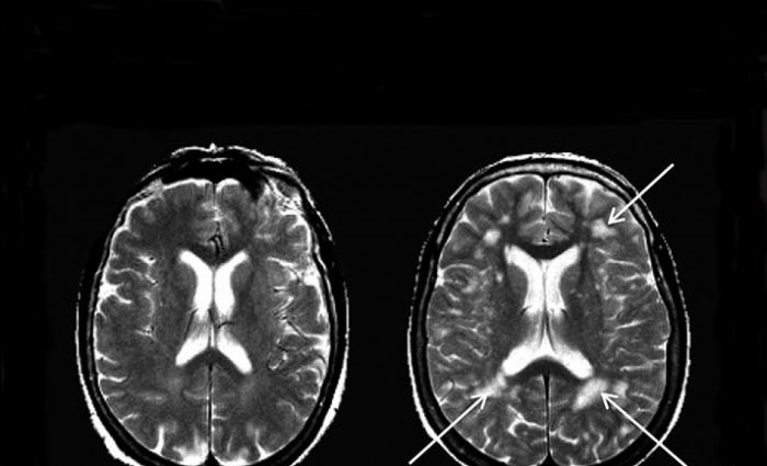 La migraine abime-t-elle le cerveau?